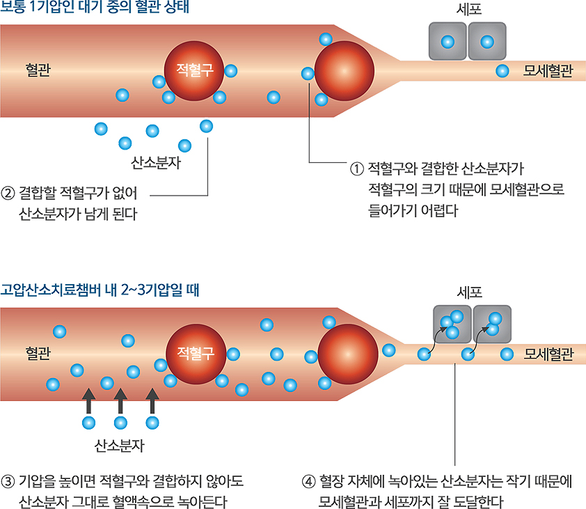 고압산소치료 원리